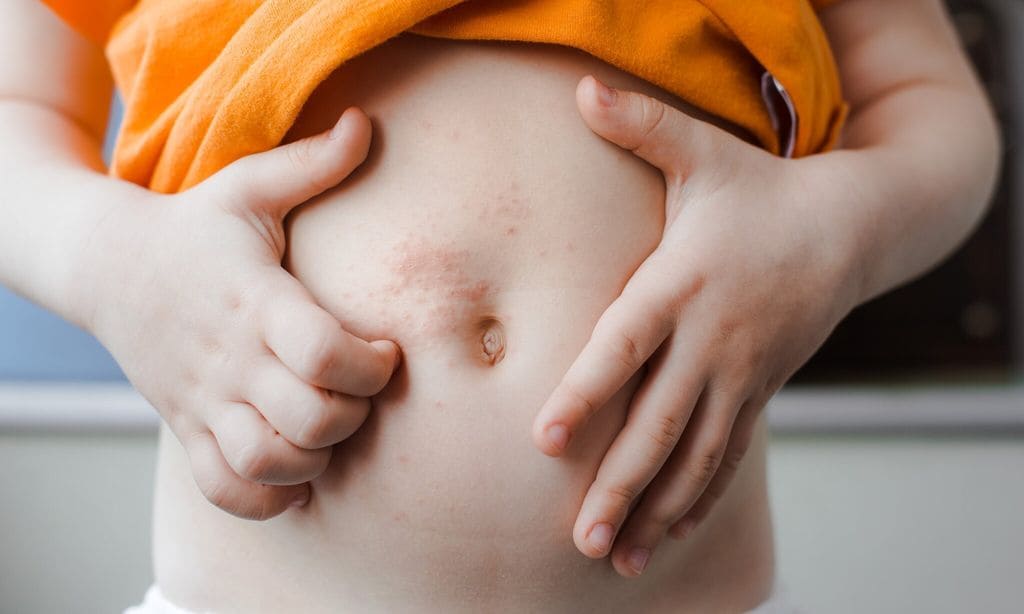 Dermatitis atópica en niños