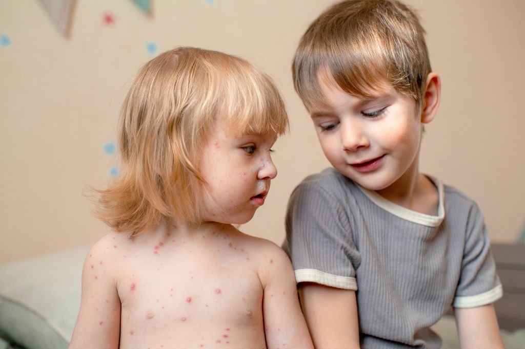 Niña con sarampión con su hermano