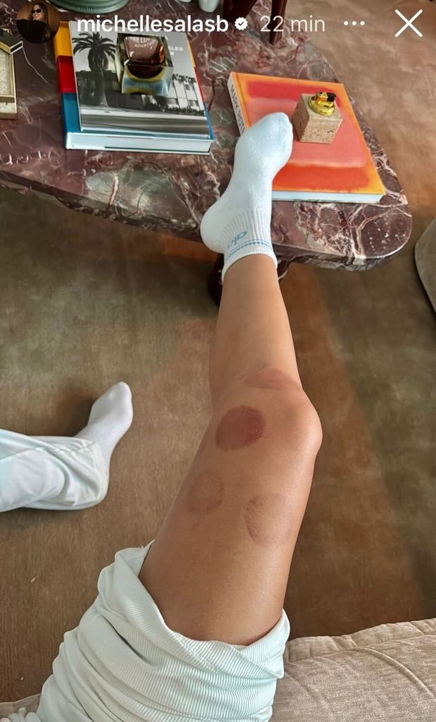 Michelle Salas mostró la lesión en su rodilla