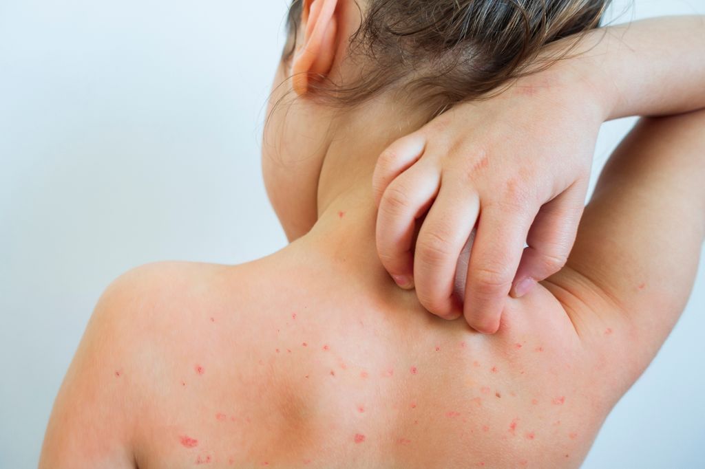 Niño con varicela rascándose la espalda