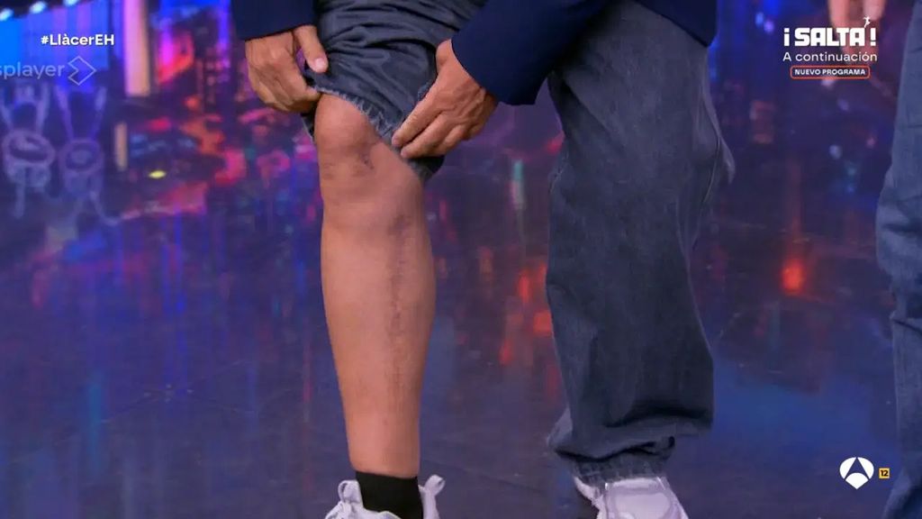 Àngel Llàcer muestra su cicatriz en El Hormiguero