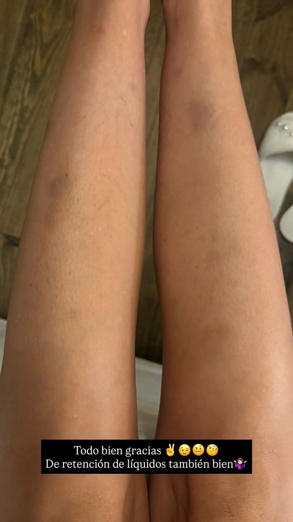 Tamara Gorro comparte una imagen de sus piernas y su "retención de líquidos" en sus redes sociales