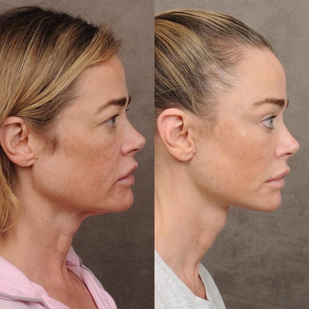 El antes y el después de Denise Richards tras su última cirugía