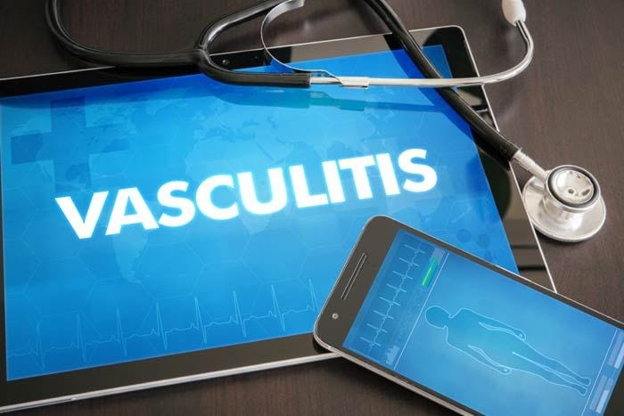 vasculitis