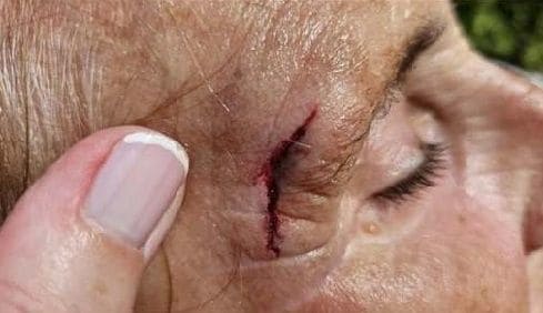 La herida de Mercedes Milá al caerse en su casa