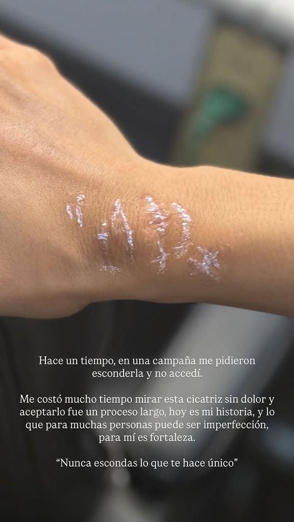 Emilia Dides compartió que se ha negado a cubrir su cicatriz pues para ella es una prueba de su fortaleza.