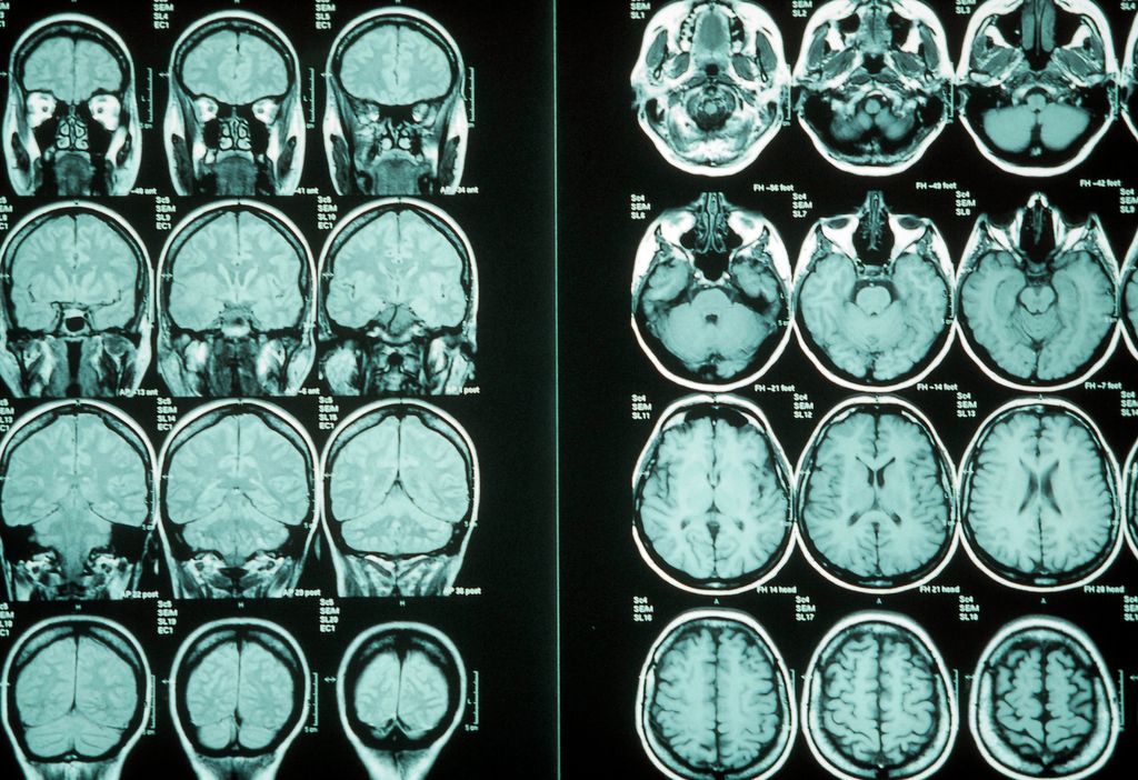 Imagen de archivo de una resonancia magnética en el cerebro.