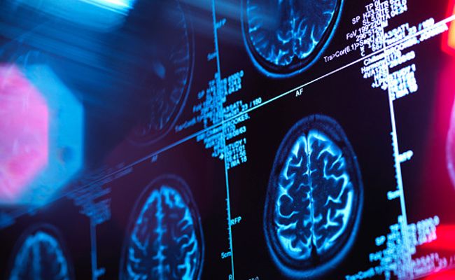alzheimer-prevenir2