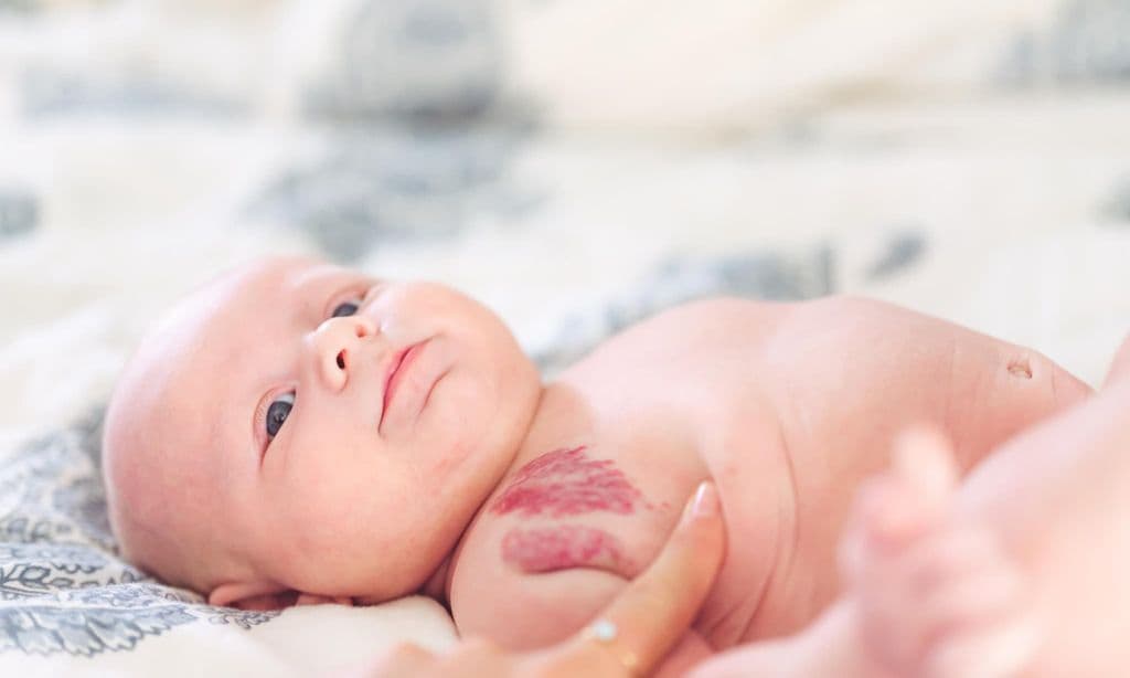 Cute little baby boy with hemangioma marks on his shoulder, infant birth marks