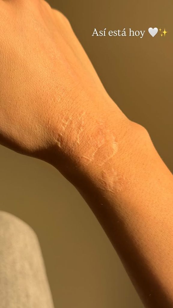 Emilia Dides mostró cómo luce ahora la cicatriz que le dejó el accidente que sufrió hace dos apños.