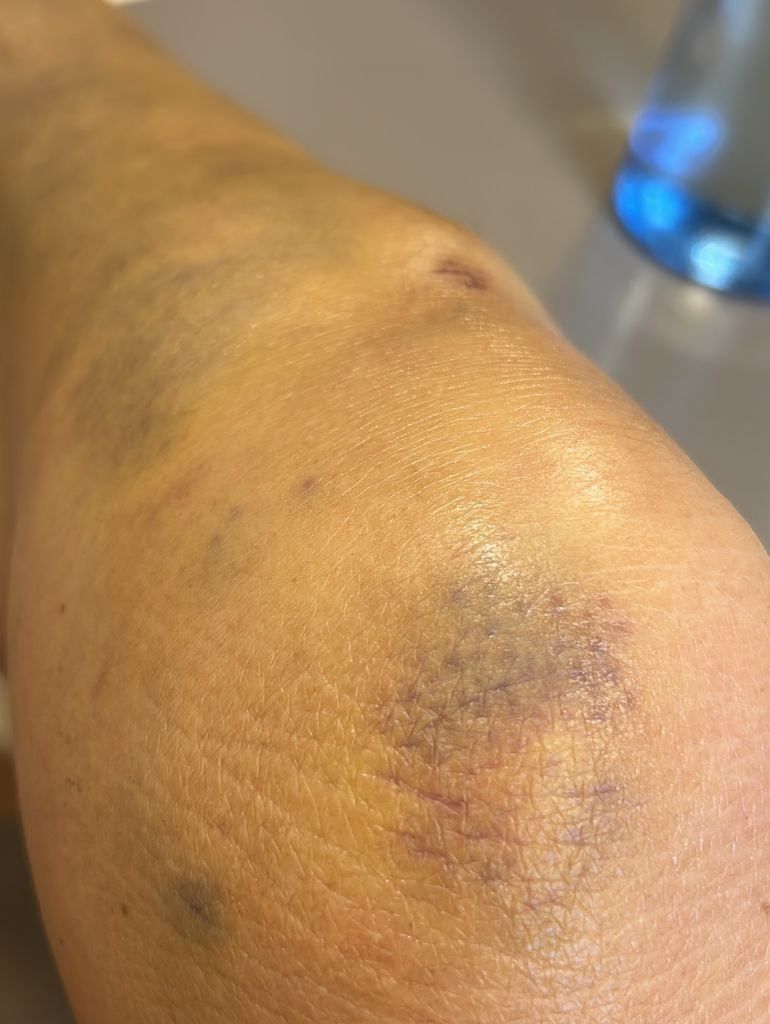 Lydia Bosch muestra las lesiones que ha tenido tras su accidente en el ensayo de su obra de teatro