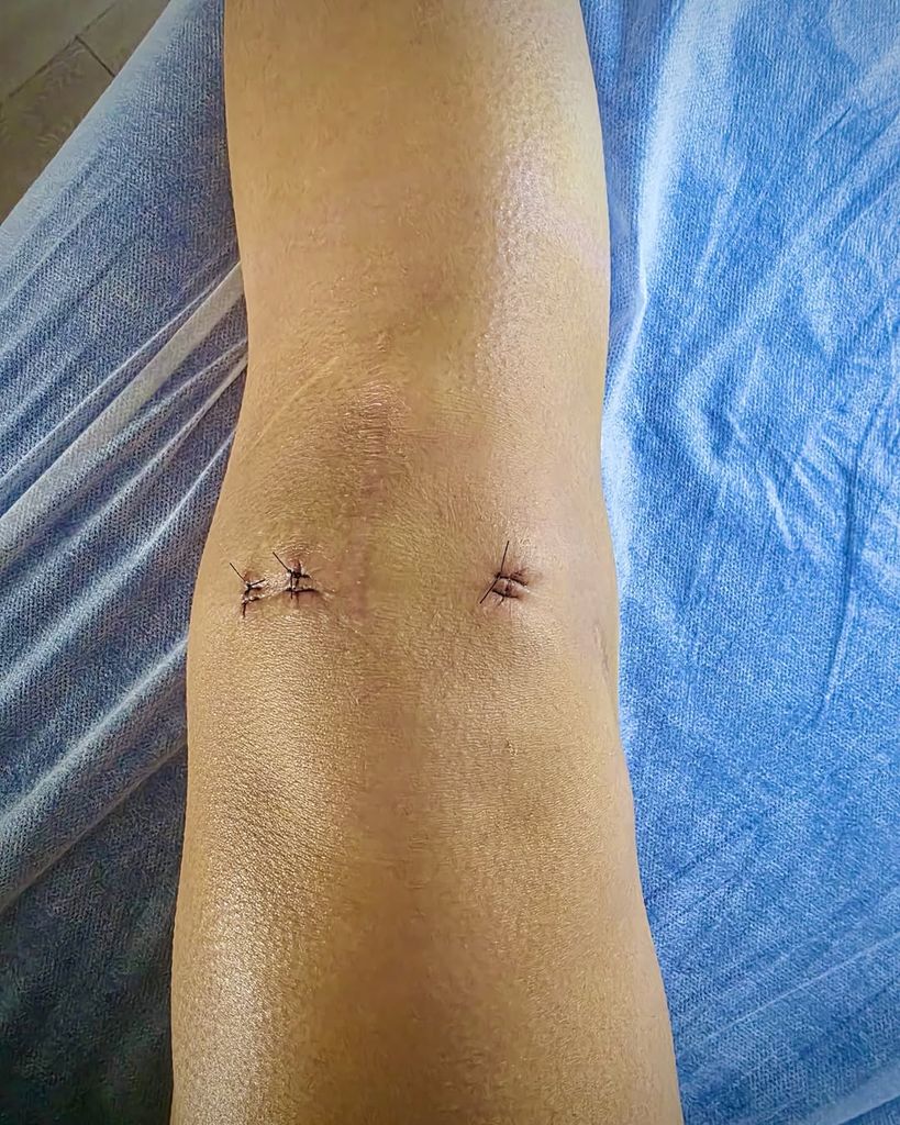 La rodilla de Carolina tras la operación
