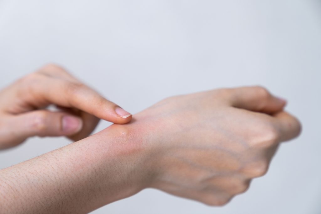 Mujer con picadura de mosquito
