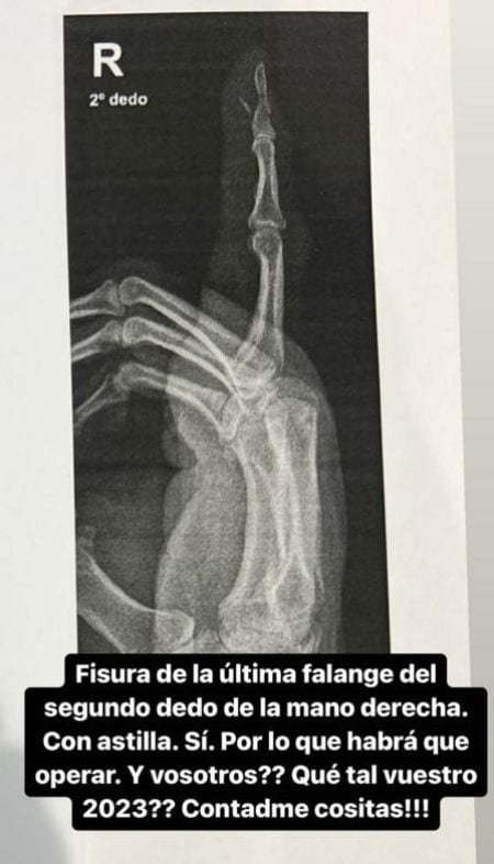 Risto Mejide muestra su dedo roto