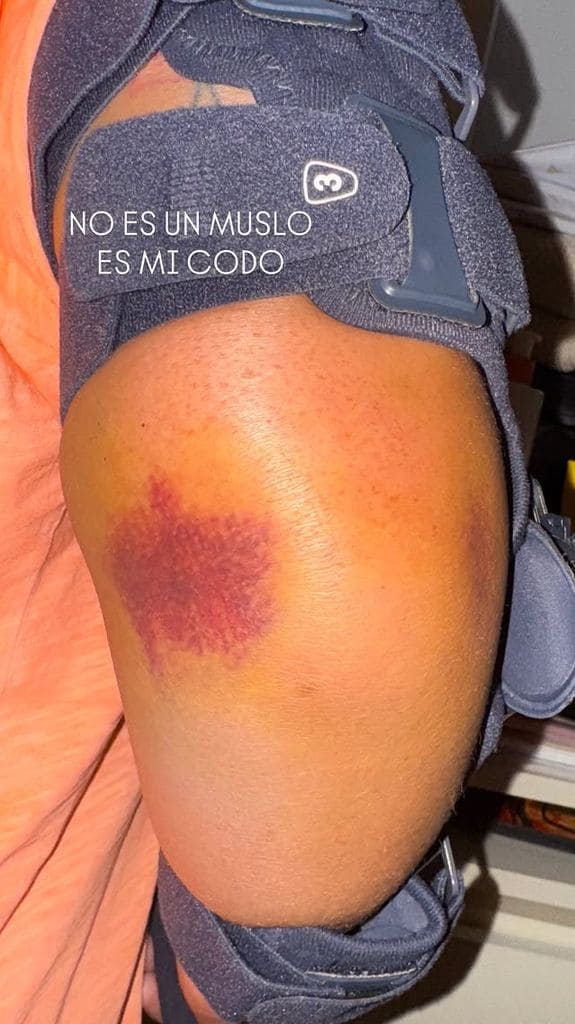 Anabel Pantoja ofrece su última hora de salud tras el accidente: "No es un muslo, es mi codo"
