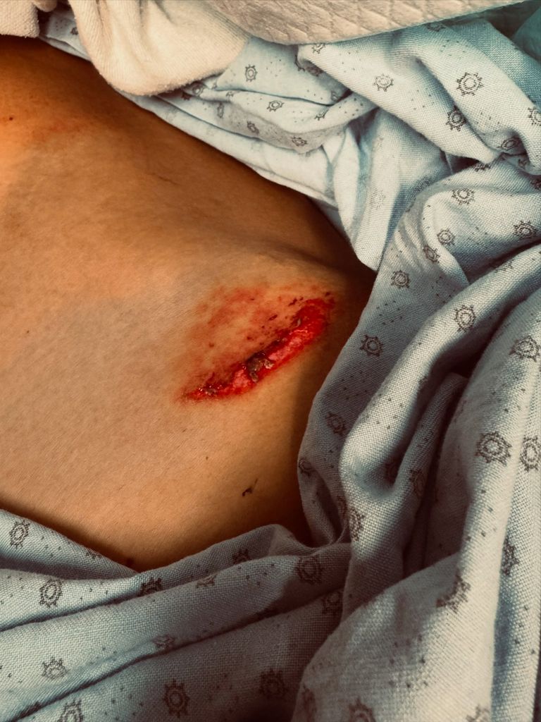 Las heridas de la ciclista tras el accidente