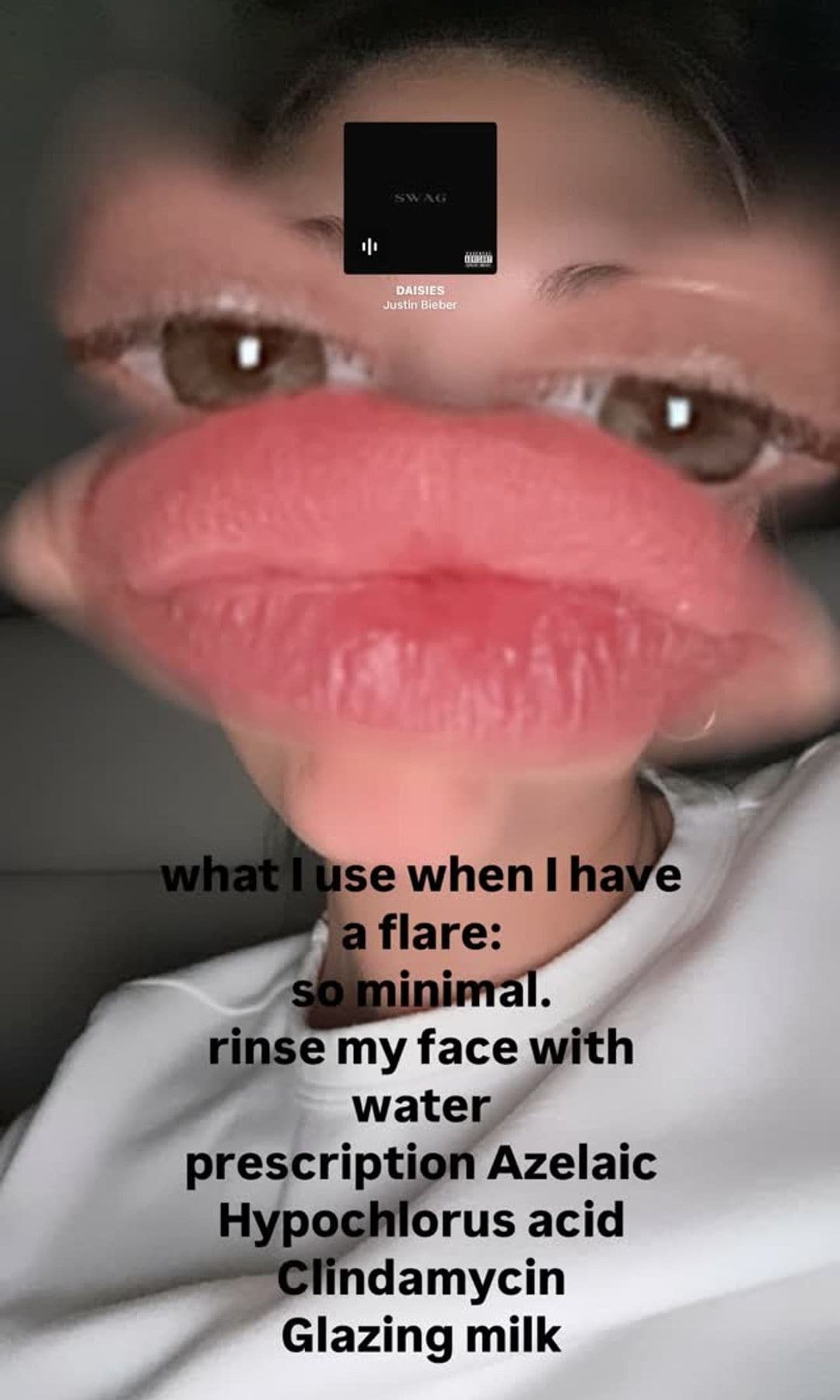 Hailey Bieber dermatitis perioral