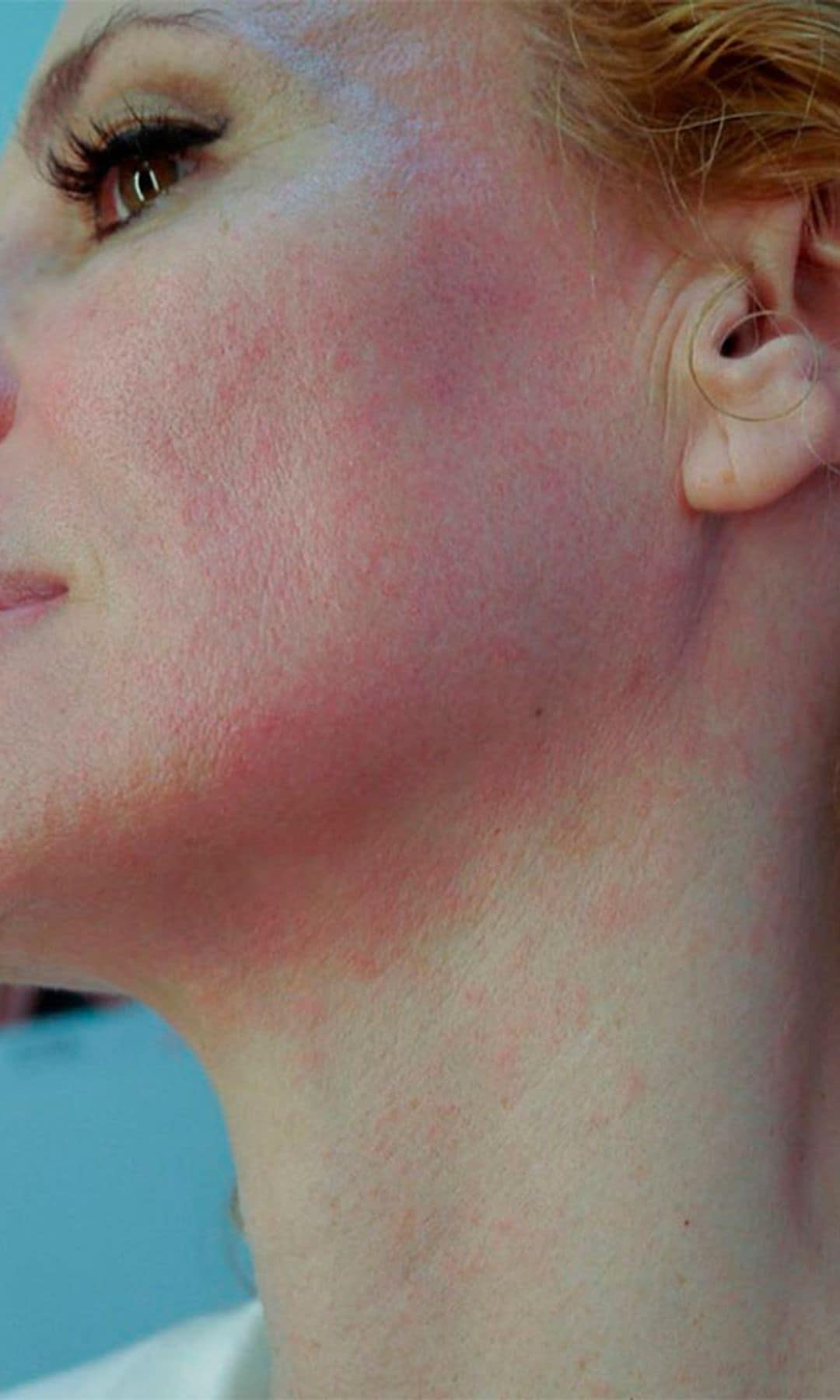 paula vazquez rosacea