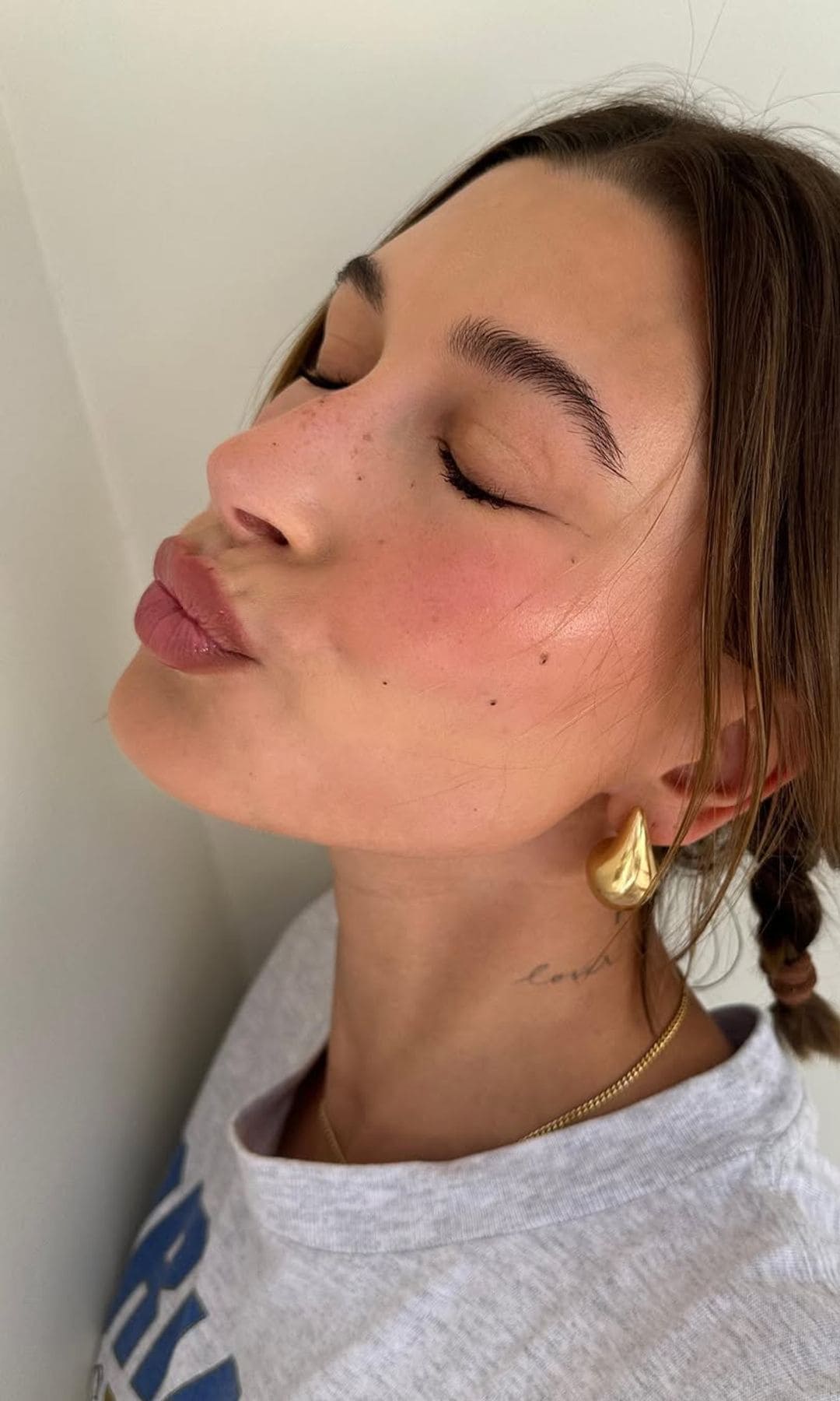 Hailey Bieber dermatitis