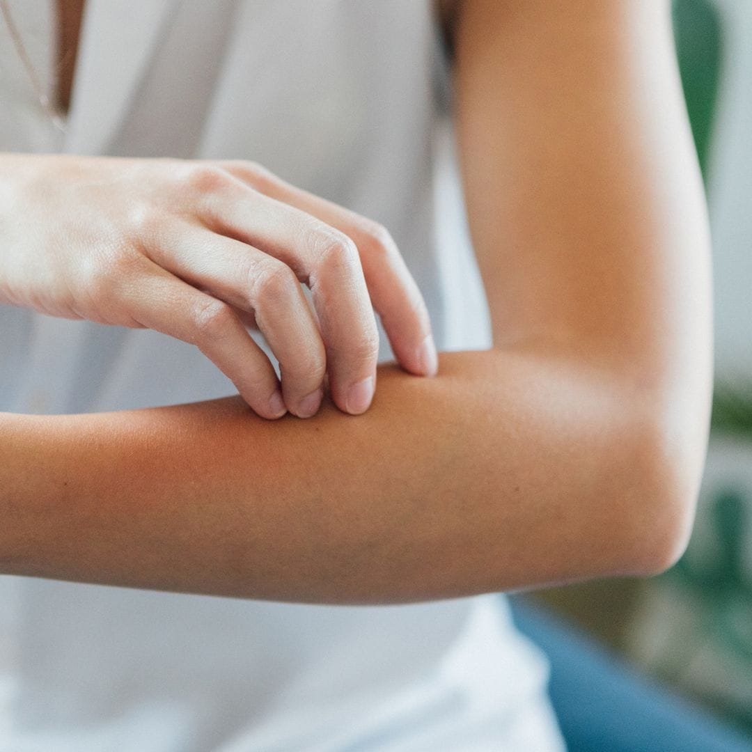 Las 6 mejores cremas para las picaduras de mosquitos que necesitas llevar en tu bolso este verano