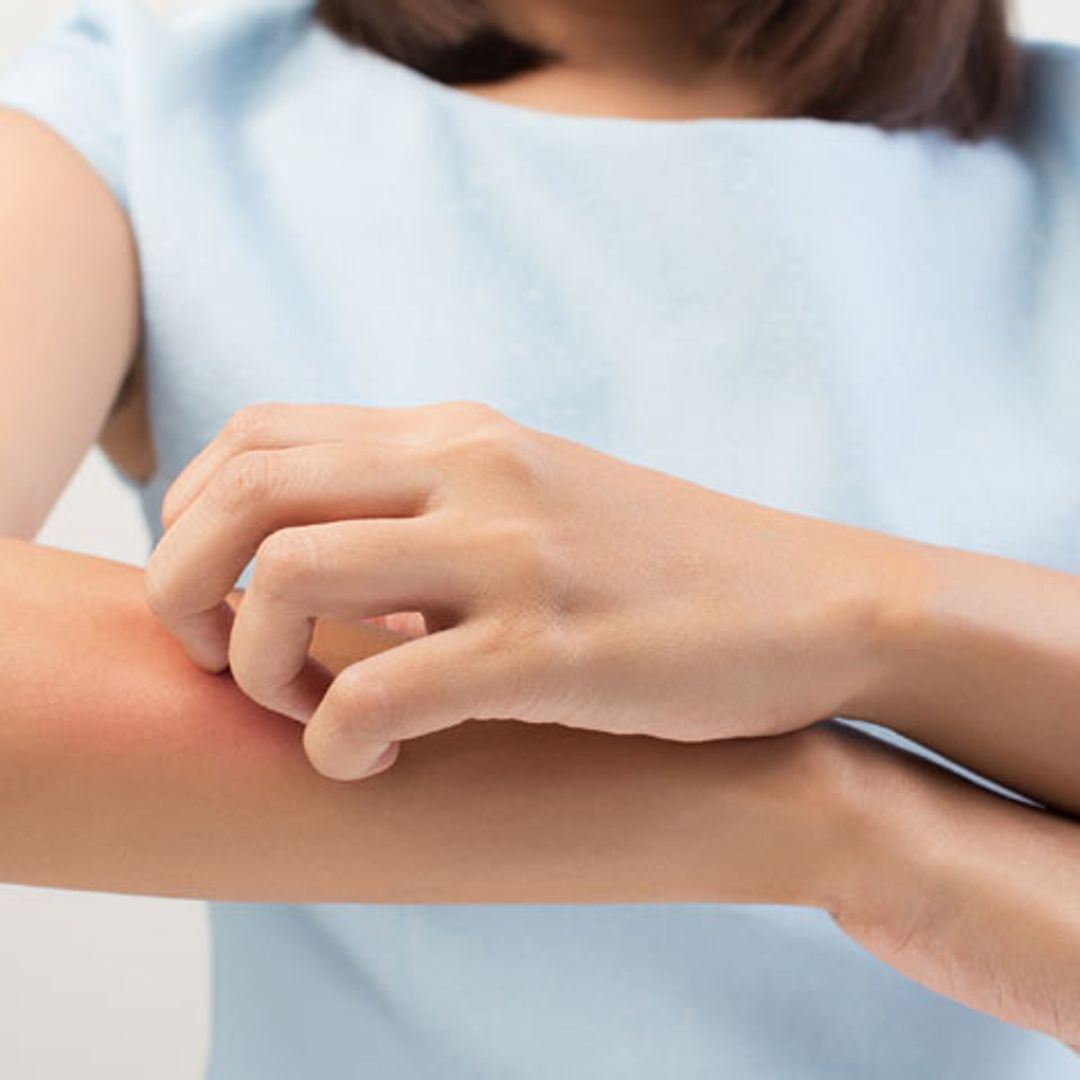 Di ¡stop! a las picaduras de mosquitos en verano