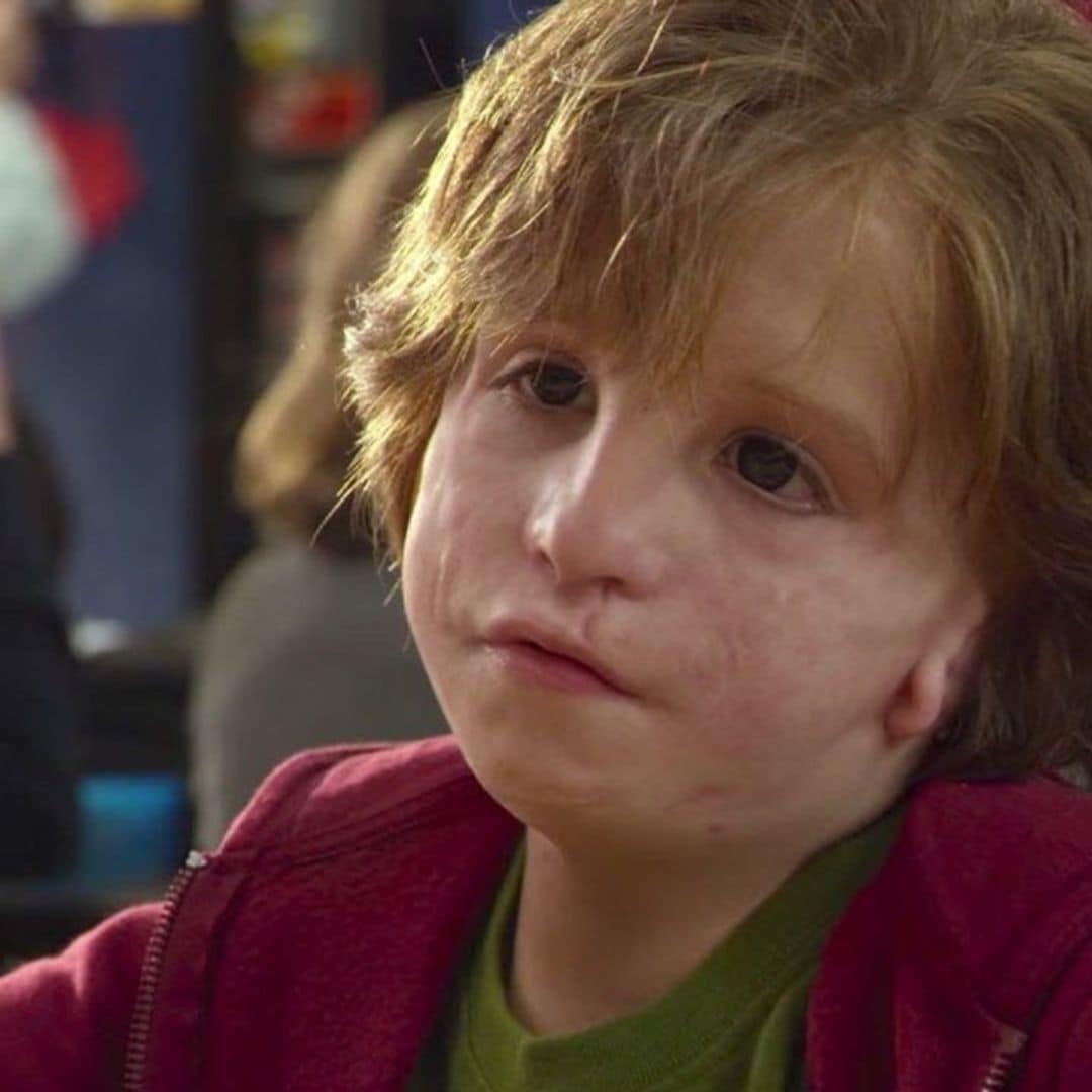 Síndrome de Treacher Collins, una enfermedad cuyo tratamiento depende de los avances tecnológicos