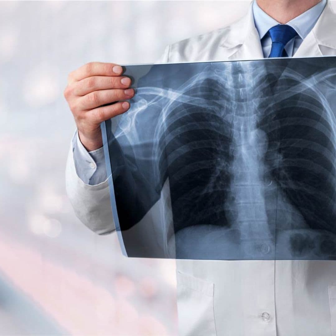 Síntomas del cáncer de pulmón, una enfermedad que cada vez afecta a más personas no fumadoras