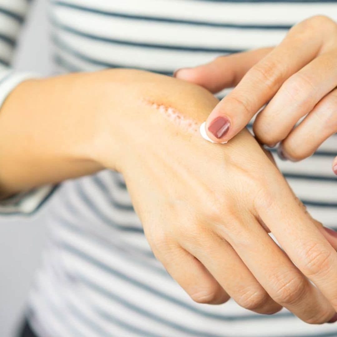 ¿Quieres evitar que te quede señal? Sigue estos consejos para curar heridas leves