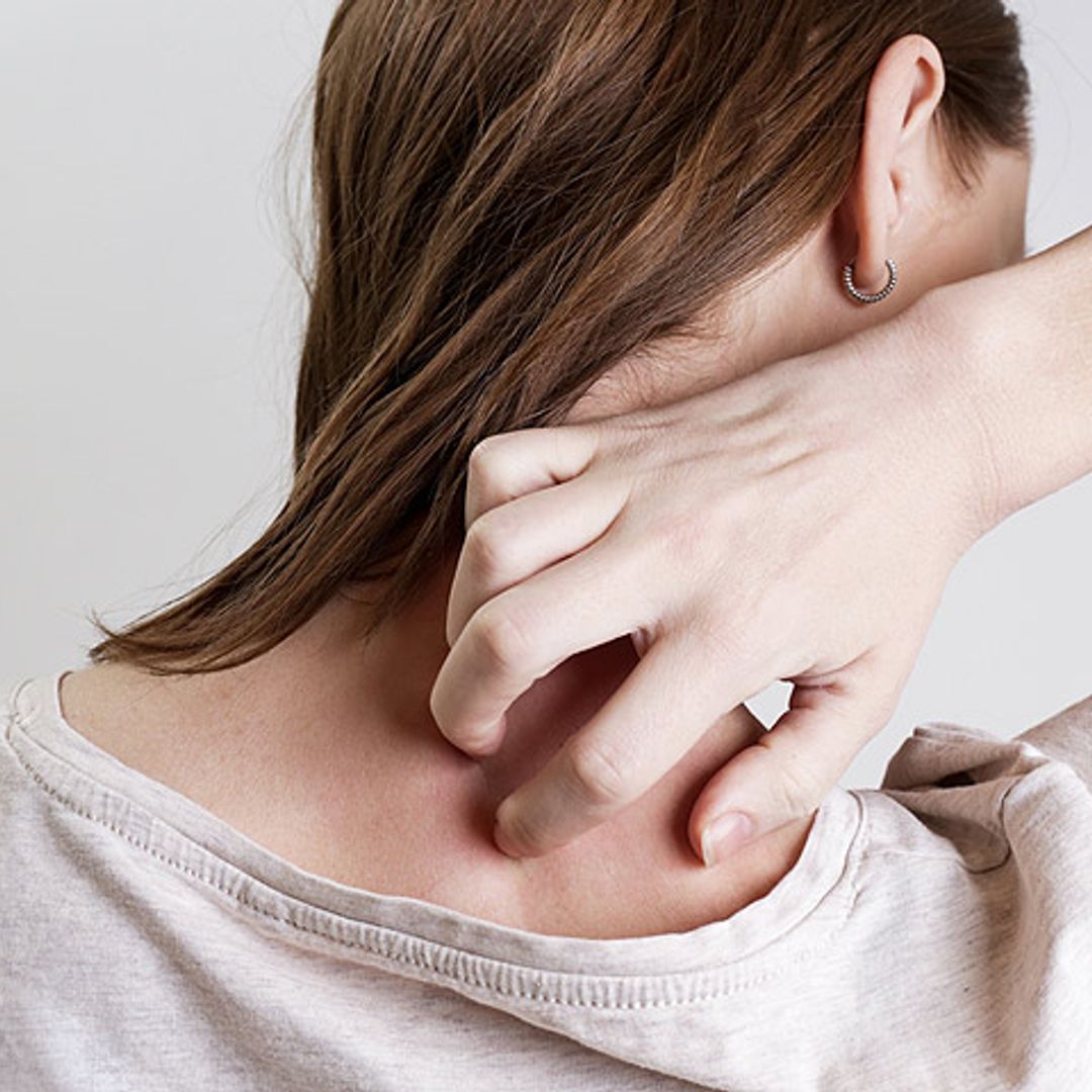 Las personas que sufren psoriasis son menos felices (según un estudio)