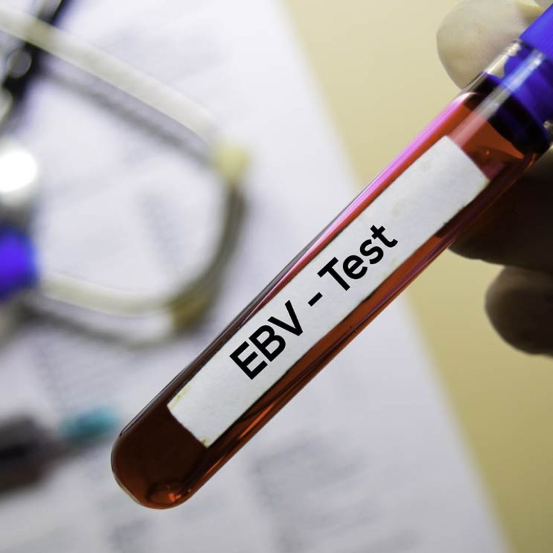 El virus responsable de la 'enfermedad del beso', posible causa de la esclerosis múltiple