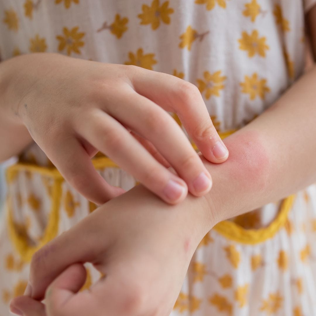 4 situaciones en que debes llevar a tu hijo a Urgencias por una urticaria, según los expertos