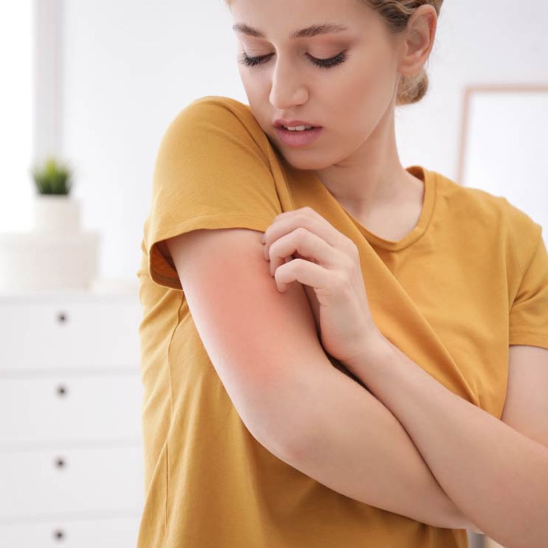 ¿Tienes alergia a algunos insectos? Esto es lo que deberías hacer