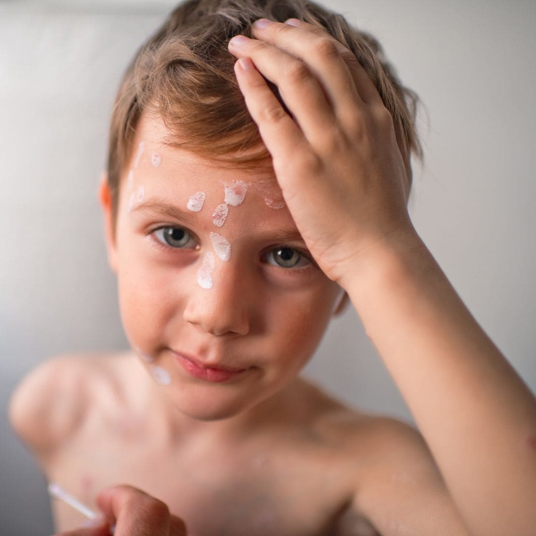 Estas son las manchas más frecuentes en la piel de bebés y niños a causa del Sol