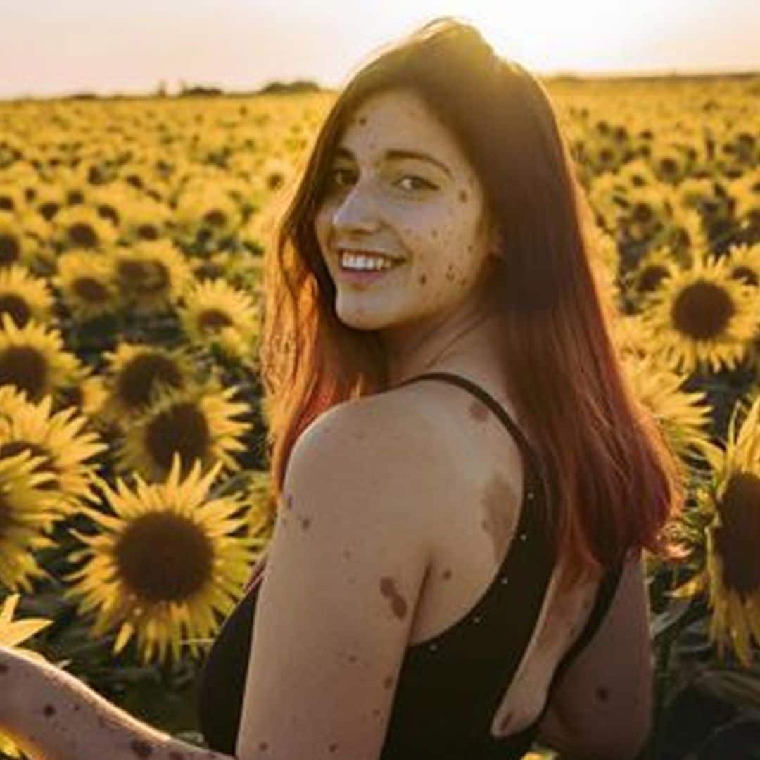 Alba Parejo, la chica de los mil lunares, que da visibilidad a las enfermedades raras