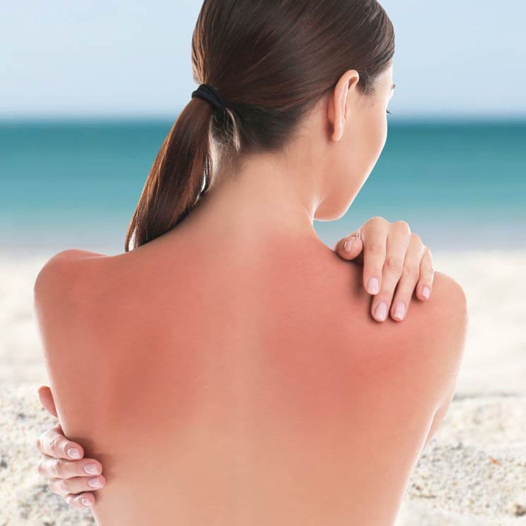 ¿Te has quemado la piel con el sol? Sigue estos consejos si quieres aliviar las molestias