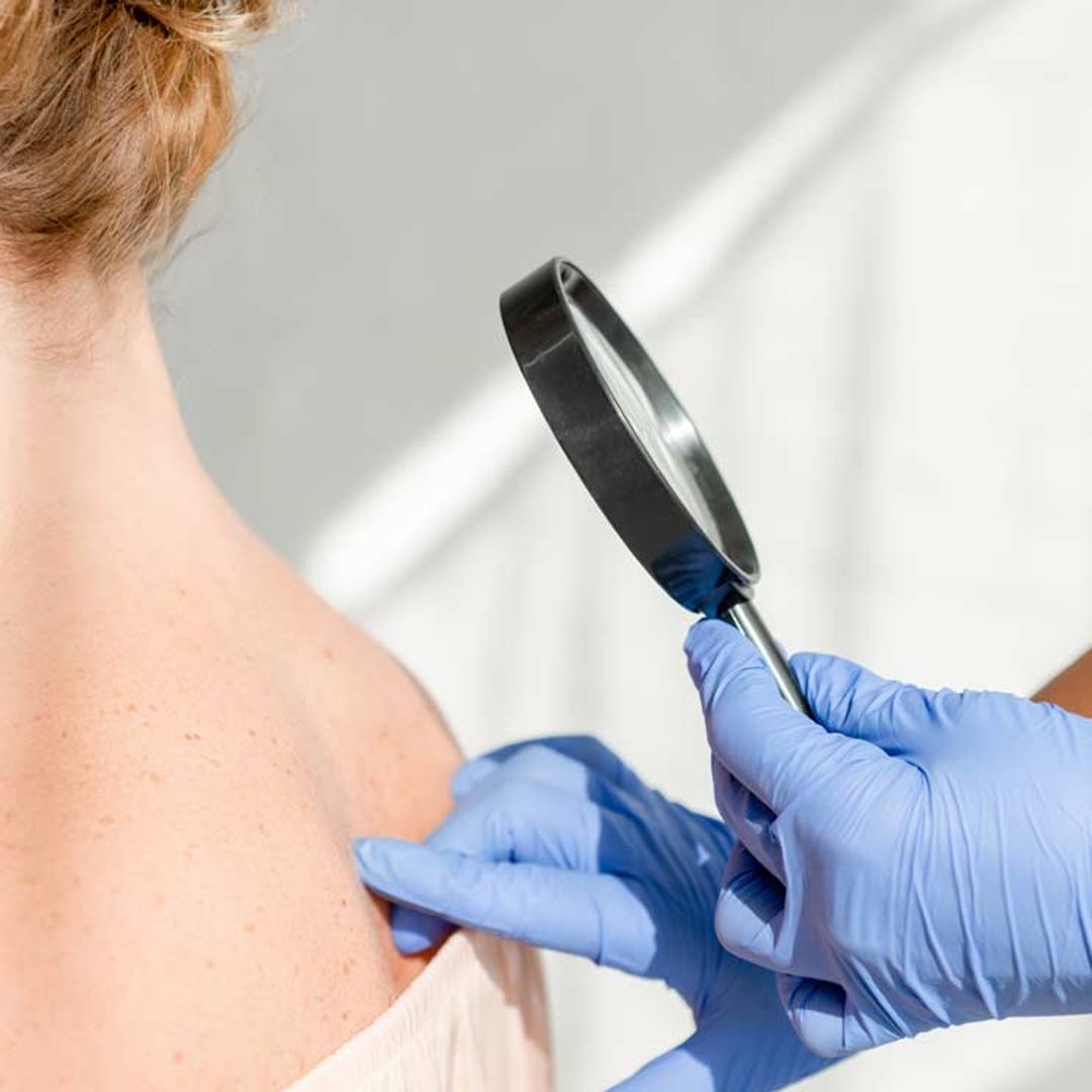 ¿Qué síntomas indican que puedes tener neurofibromatosis?