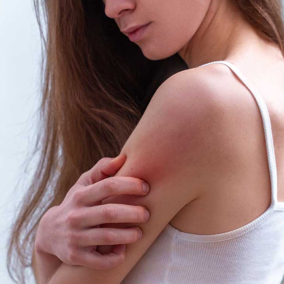 Vivir con psoriasis: todo lo que debes saber sobre esta enfermedad de la piel