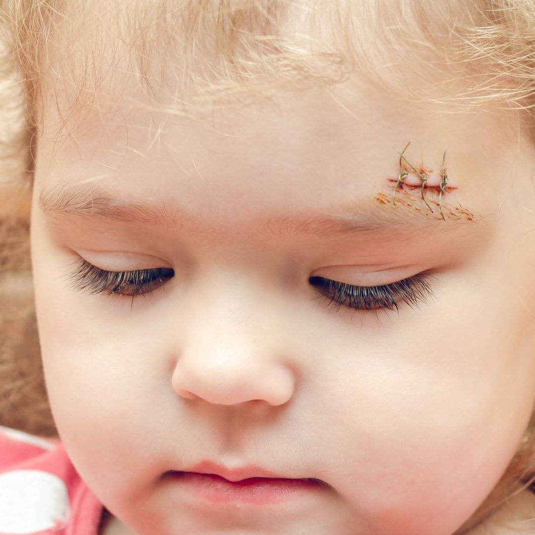 Dr. Alessandro Thione, cirujano plástico, sobre las cicatrices en los niños: “Si siente que ‘eso’ es lo primero que ven de él, puede afectar a su manera de relacionarse”