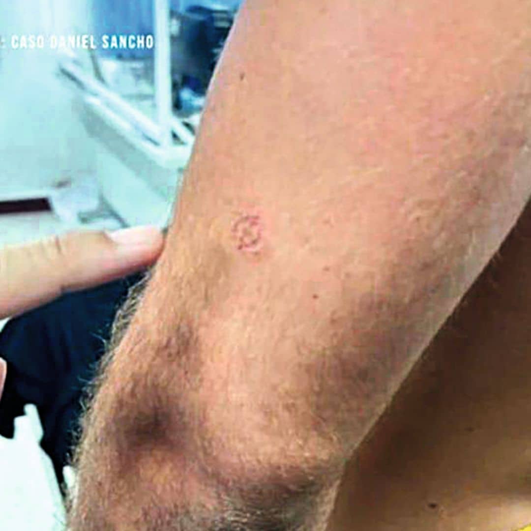 Algunas de las fotos que la Policía hizo de las lesiones sufridas por Daniel Sancho el día del asesinato de Edwin Arrieta