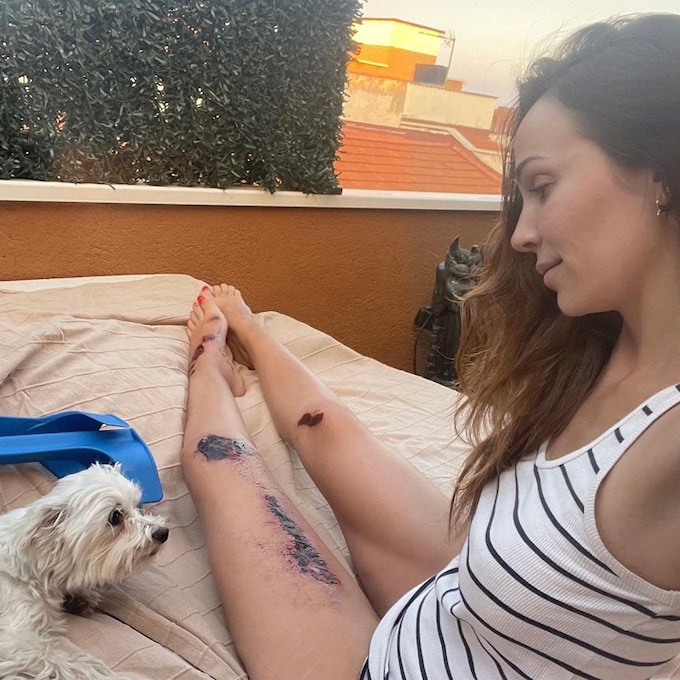 Nerea Garmendia sufre un accidente de moto y muestra sus heridas