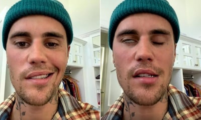 Las imágenes de la parálisis facial de Justin Bieber que le ha obligado a cancelar sus conciertos