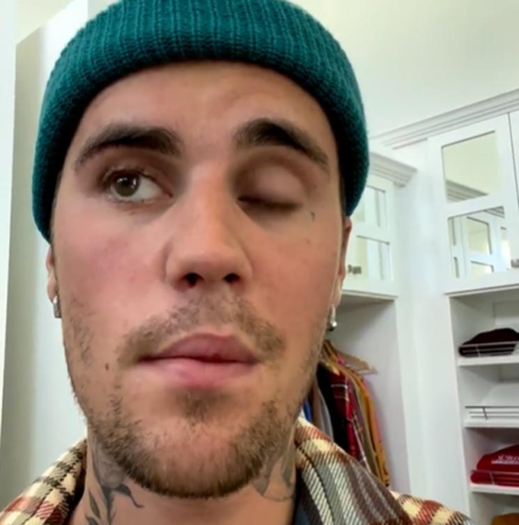 Justin Bieber comparte cómo evoluciona la incapacitante parálisis facial que sufre