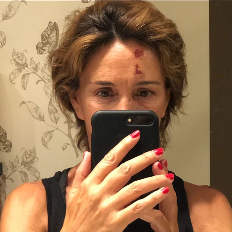Lydia Bosch muestra las heridas de su rostro tras sufrir un accidente con un skate