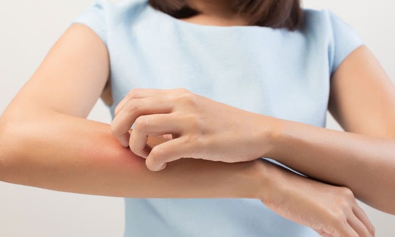 Resultado de imagen para picaduras de mosquito