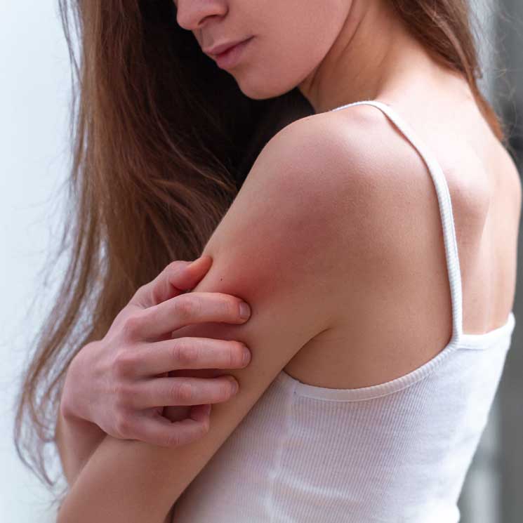 Vivir con psoriasis: todo lo que debes saber sobre esta enfermedad de la piel