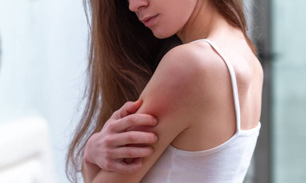 12 preguntas con respuesta sobre la dermatitis atópica