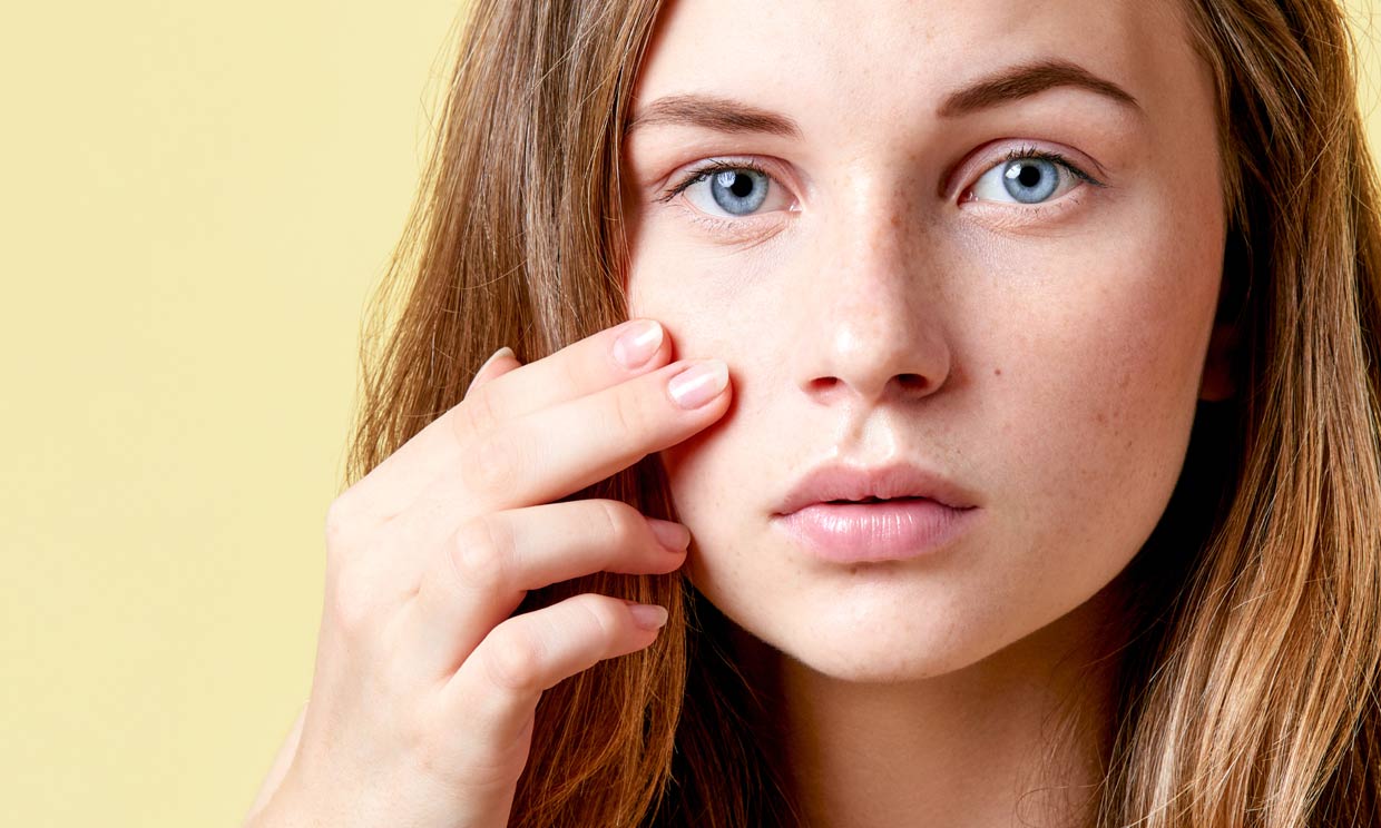 ¿Se pueden eliminar las cicatrices del acné?