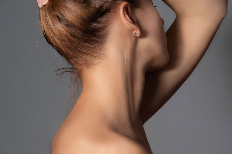 cicatriz en el cuello