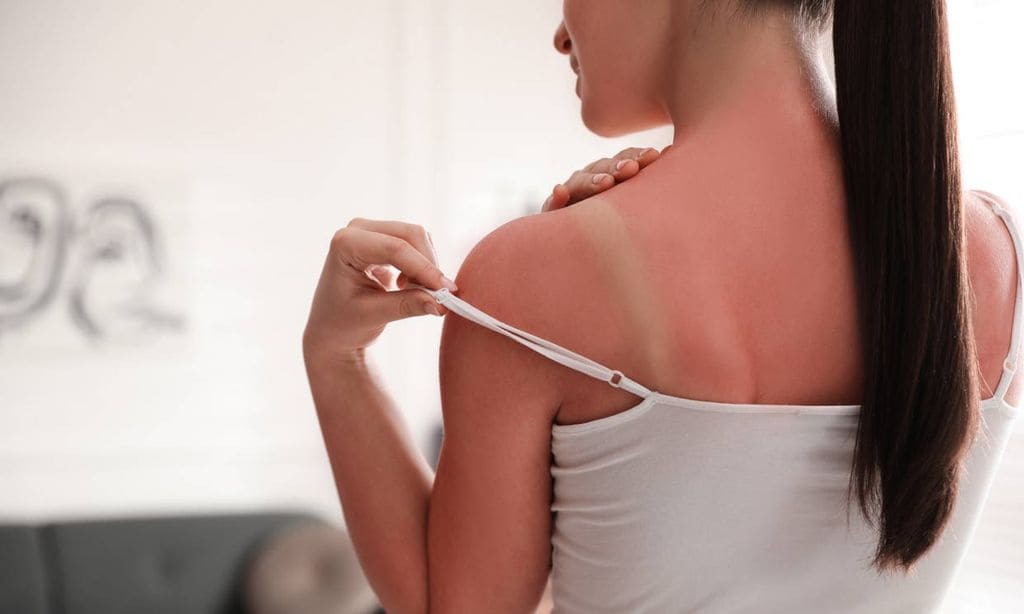 Decálogo de consejos para aliviar y cuidar una quemadura solar
