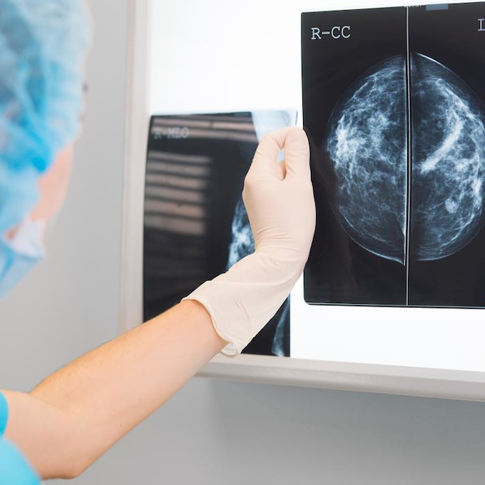 Apoyo, información e investigación, elementos clave para las mujeres con cáncer de mama metastásico
